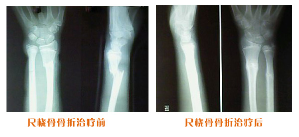尺橈骨克雷氏骨折治療前后
